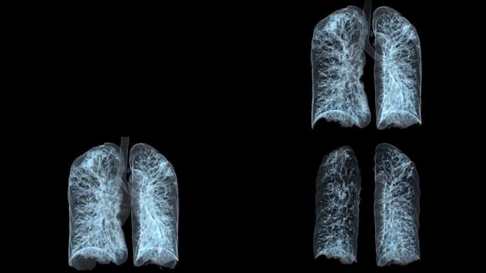 CT胸部或肺部3D渲染用于诊断结核病，结核病和covid-19。