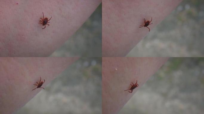 危险的寄生虫硬蜱在人的皮肤上。