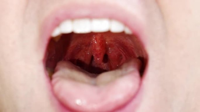 一个男人的嘴特写。腭悬雍垂和咽喉粘膜。