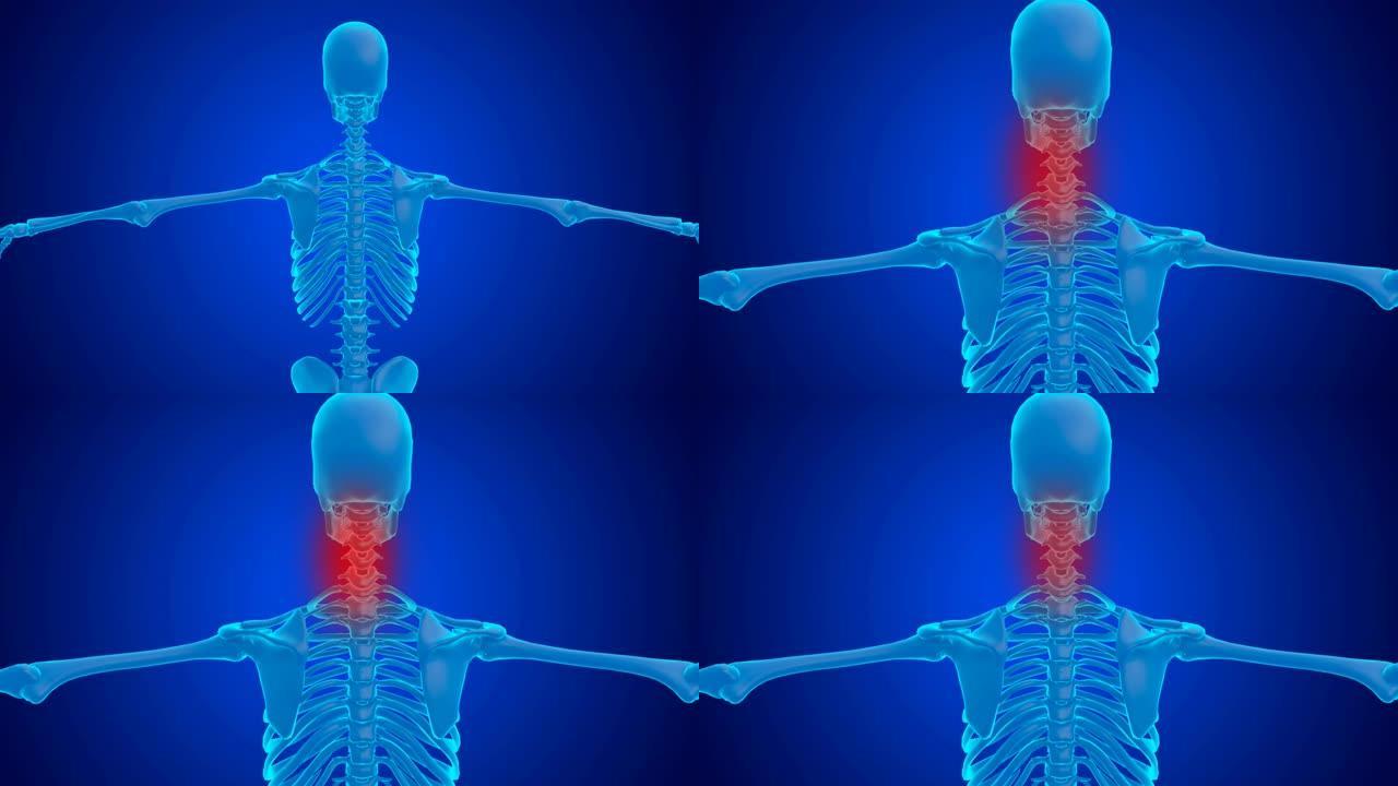 椎骨受压引起的蓝色全息人体颈椎疼痛