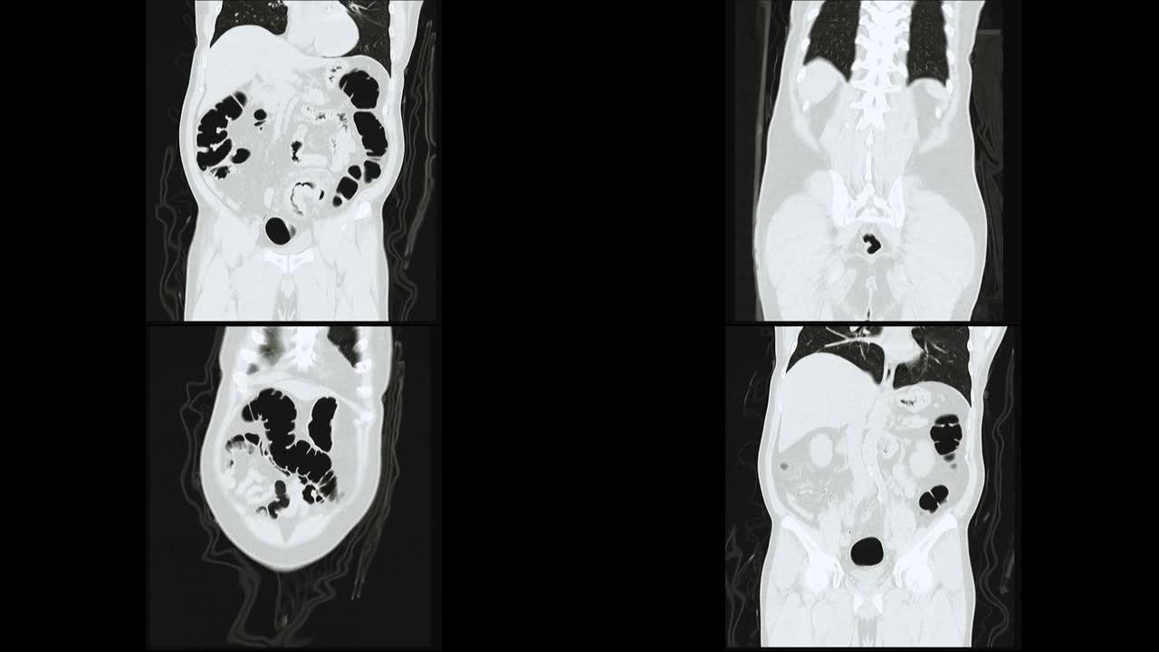 CT结肠造影冠状视图。