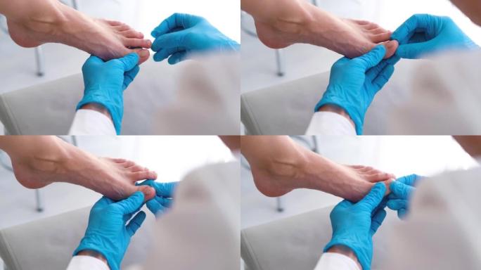 医生戴着手套检查指甲上有真菌的1英尺特写镜头。甲癣: 指甲从甲床上脱离。