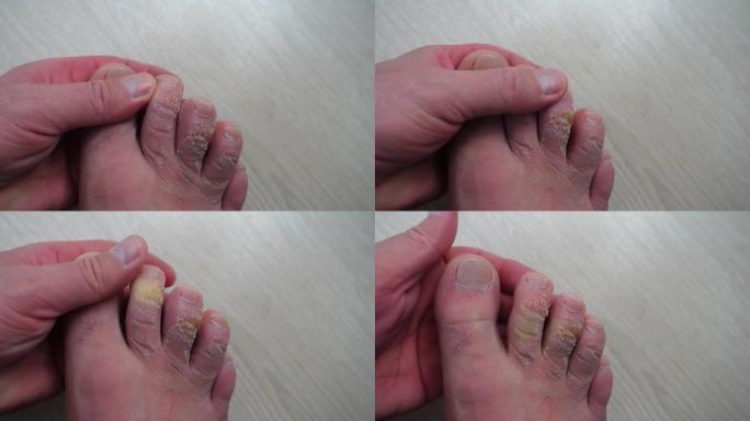 脚趾上有老茧的人抓伤他的手指，检查它们，老茧的手指，