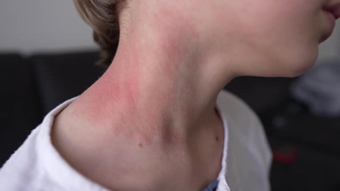 儿童颈部和面部过敏性皮肤反应-红疹。光致皮炎的症状。对阳光过敏反应。