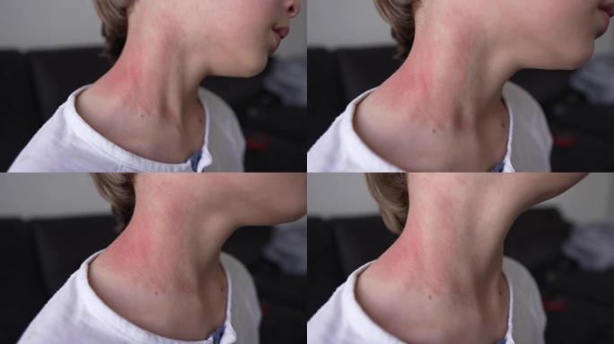 儿童颈部和面部过敏性皮肤反应-红疹。光致皮炎的症状。对阳光过敏反应。