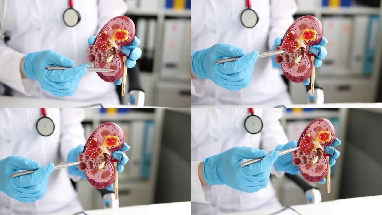 医生用笔展示人类肾脏人工模型的疾病特写4k电影