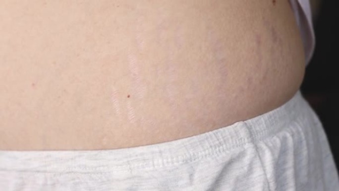 特写的身体有妊娠纹和疤痕，失去弹性。女孩显示皮肤受损。