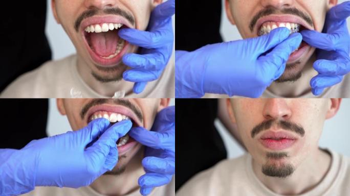 正畸医生将硅胶隐形透明牙套放在人的牙齿上
