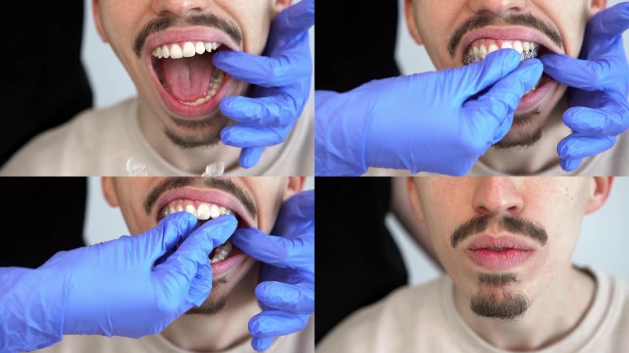 正畸医生将硅胶隐形透明牙套放在人的牙齿上