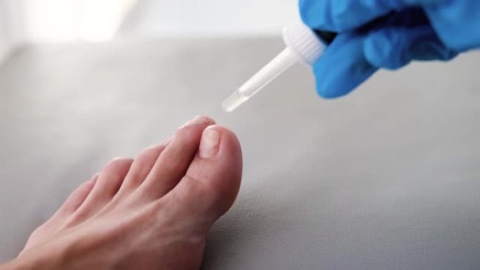 医生将药物从移液器滴到疼痛的手指上。与指甲真菌的1英尺特写。甲癣: 指甲从甲床上脱离。