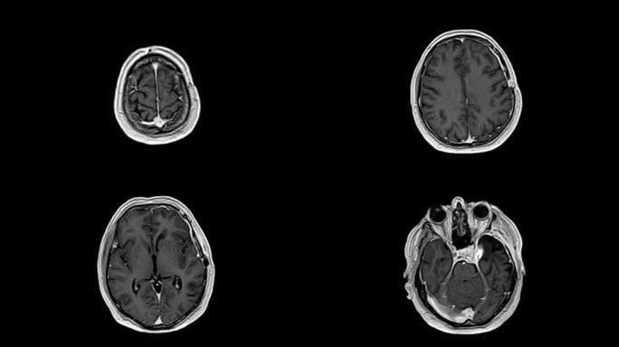 对患有部分切除的脑肿瘤的男性患者进行MRI检查