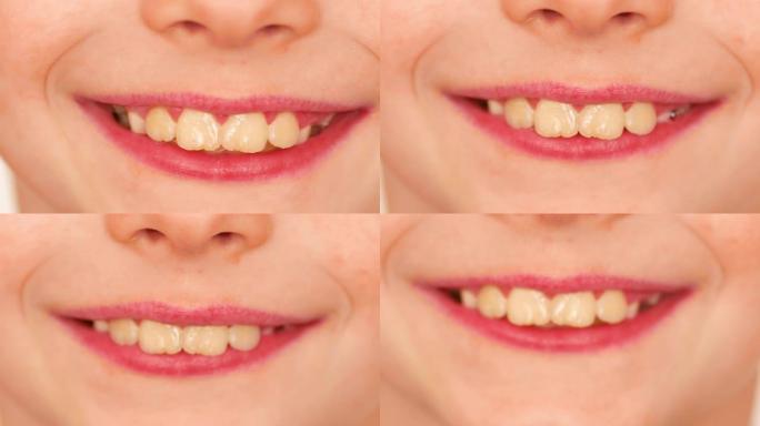 一个学龄的高加索男孩的嘴唇和牙齿的特写微笑。一个7岁的小男孩真诚地微笑着。宏观。孩子面部的一部分的细