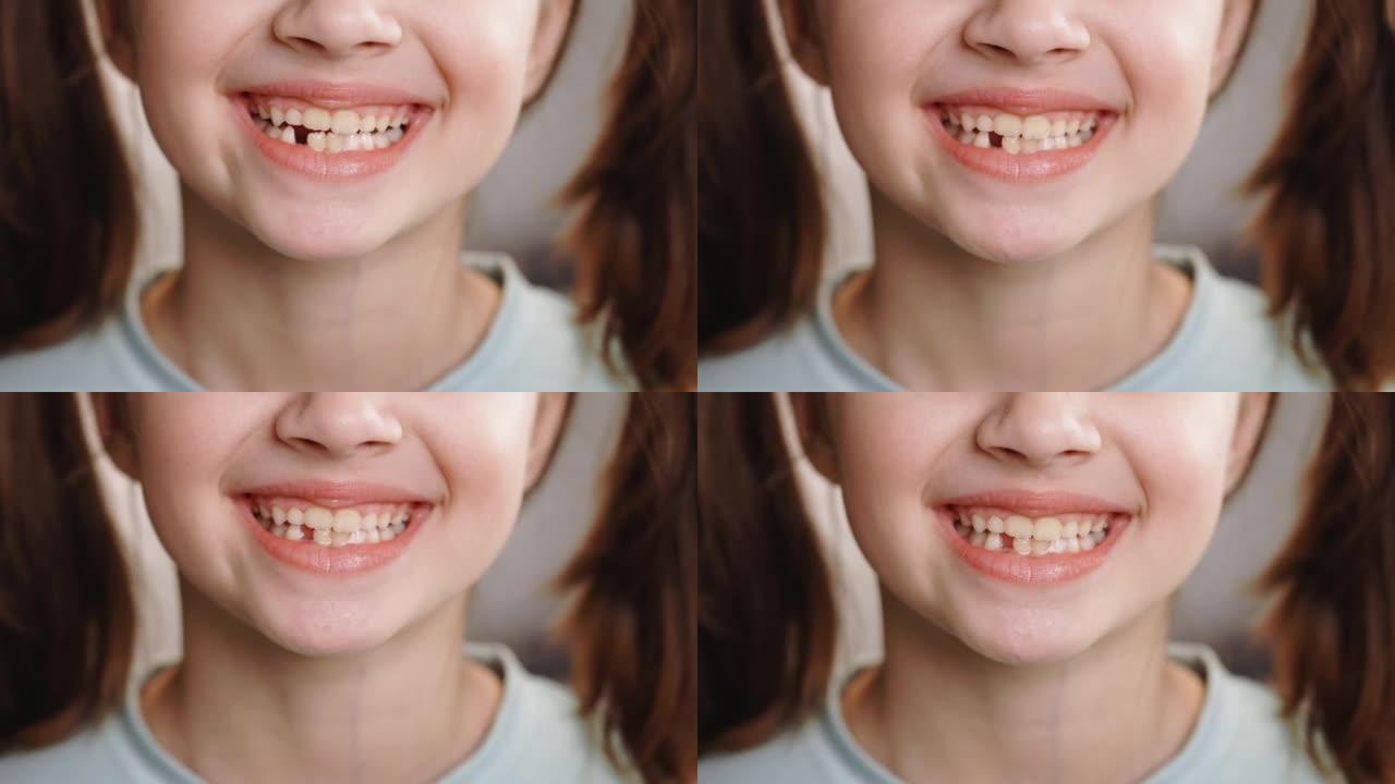 年轻的高加索小女孩微笑着无牙微笑的特写肖像。乳牙脱落，恒牙更换。儿童是牙科。没有牙齿。去除乳牙