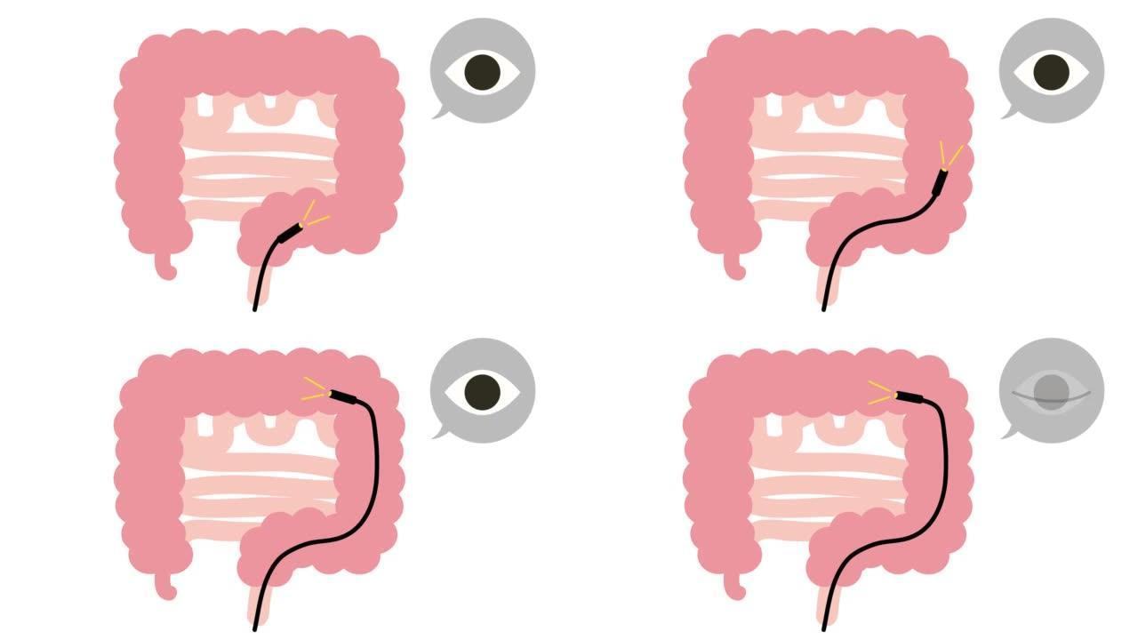 这是一个关于结肠镜检查的动画视频。