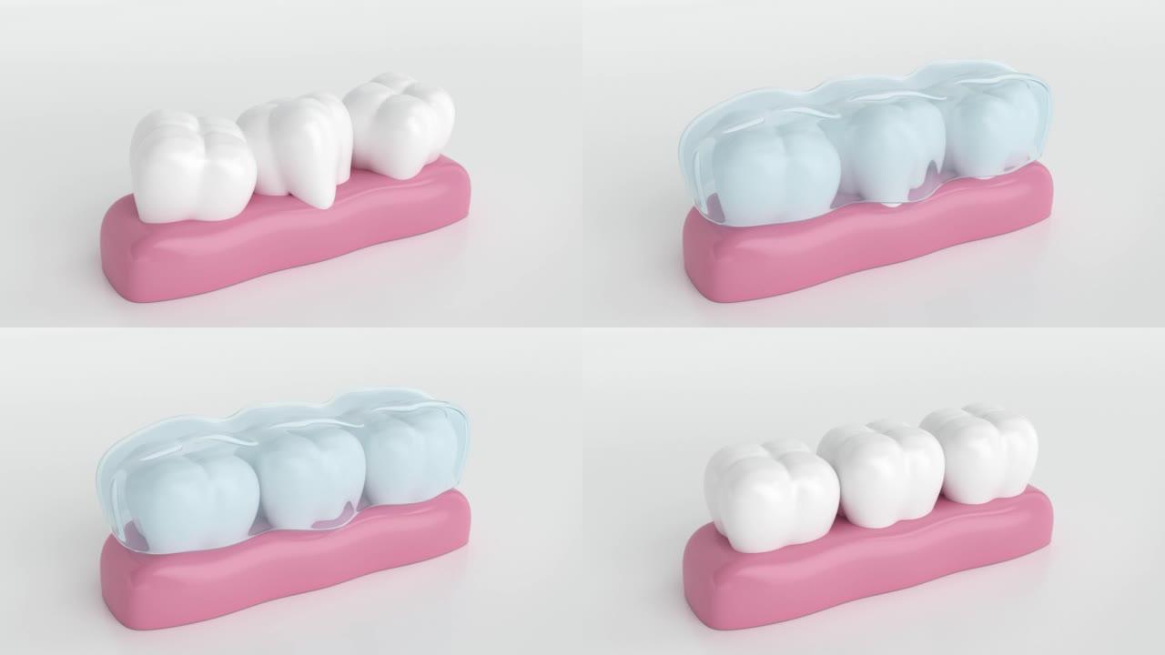 隐形牙套，隐形牙套，带隐形牙套的快乐牙齿，3d动画