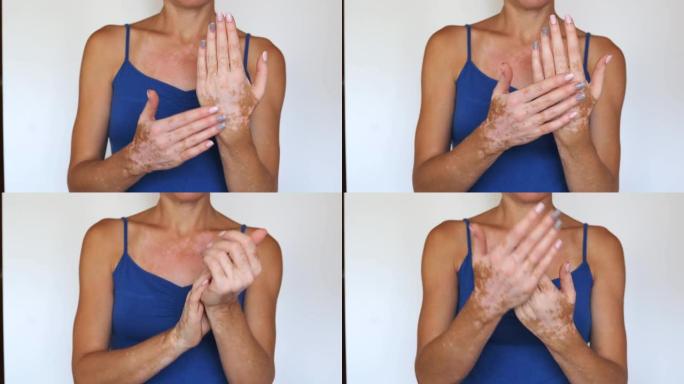 一个无法识别的白癜风斑点的女人的特写镜头，在她的手的皮肤上涂上治疗霜。多样性体积极接受概念。