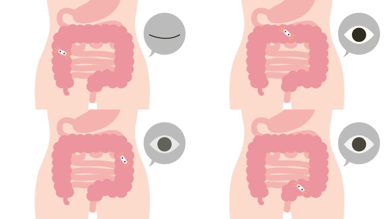 这是一个胶囊结肠镜检查的动画视频。