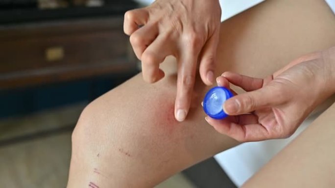 女人用乳霜治疗大腿上的红色皮疹 (或瘀伤)。