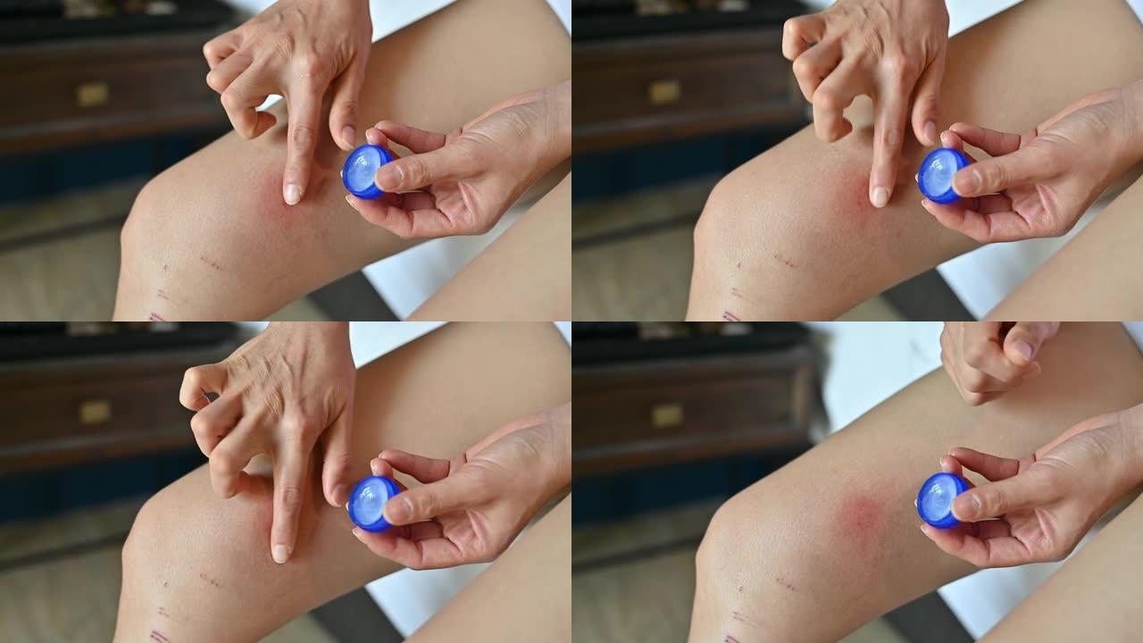 女人用乳霜治疗大腿上的红色皮疹 (或瘀伤)。