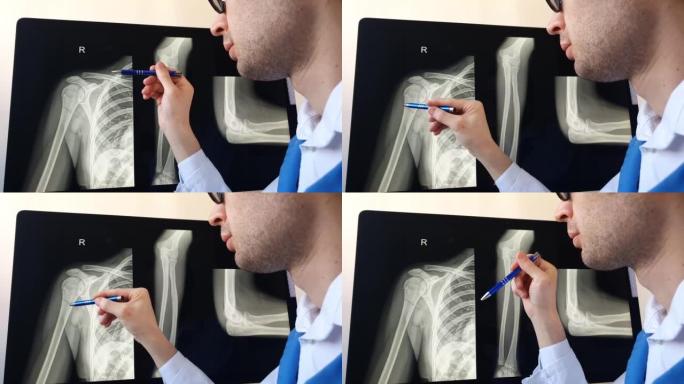 放射科医生分析患有肱骨骨折的患者手臂和前臂骨骼x射线。