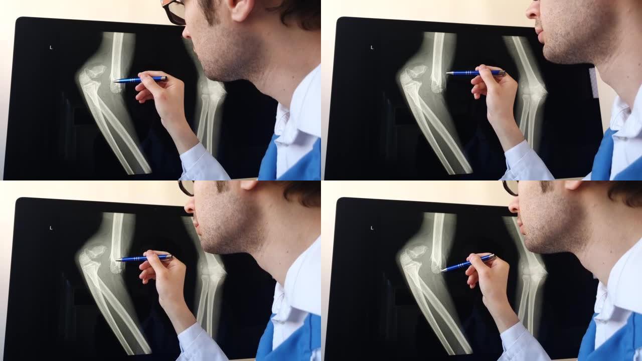 放射科医生分析患有肱骨骨折的患者手臂和前臂骨骼x射线。