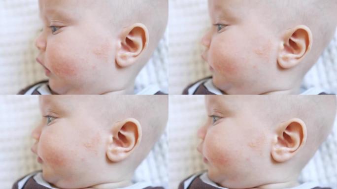 婴幼儿皮肤问题皮炎过敏性皮疹丘疹儿童红脸