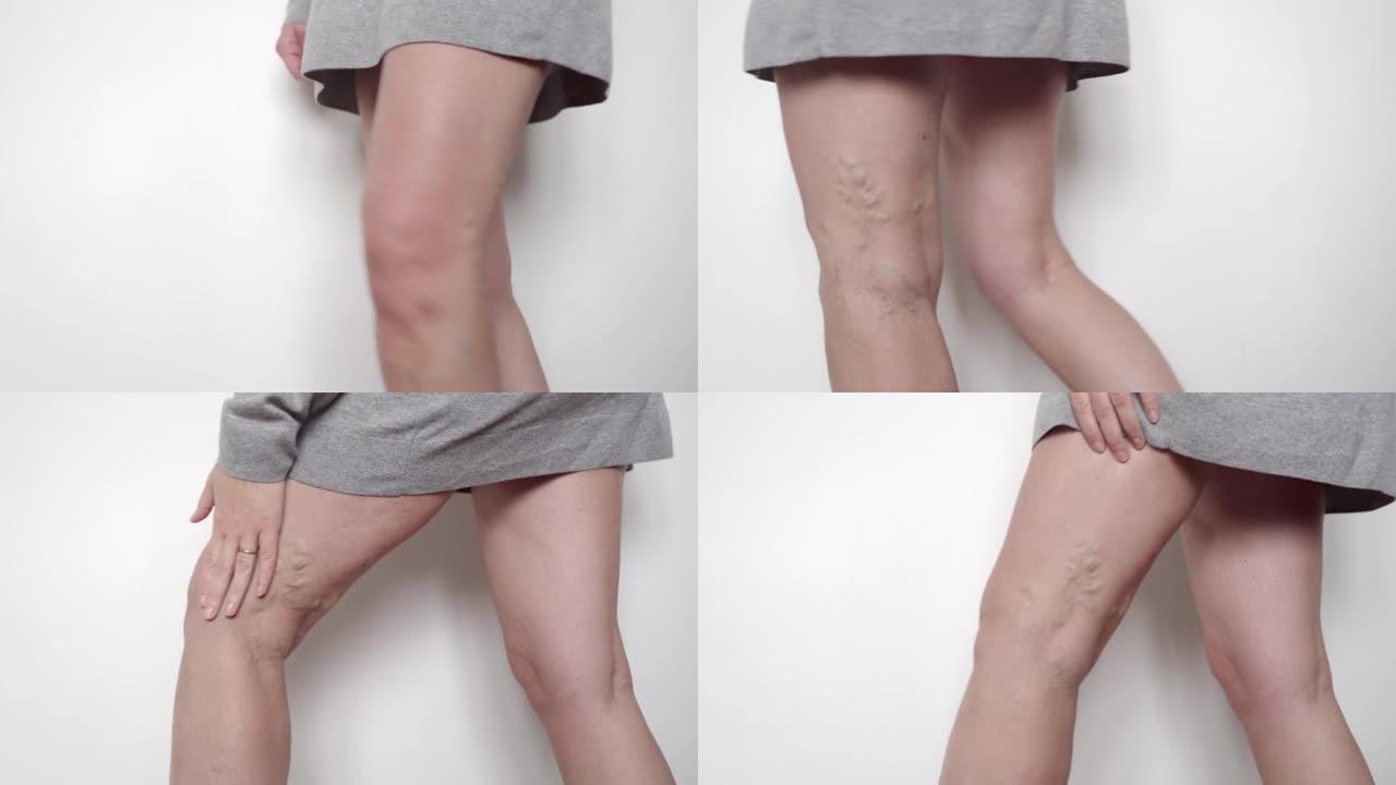女性腿部静脉曲张的特写。蜘蛛腿部静脉纹理，血管医学问题。老年妇女护理