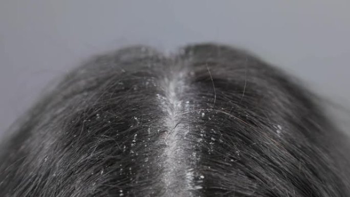 头皮屑的肮脏黑发特写。顶视图。相机从前额沿头发分开的移动。头皮疾病的概念