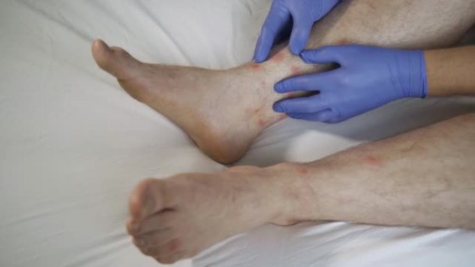 医生诊断为足部牛皮癣。皮肤受损。皮炎，湿疹，银屑病，过敏反应。特写-一个人脚上的剥皮和开裂。真菌感染