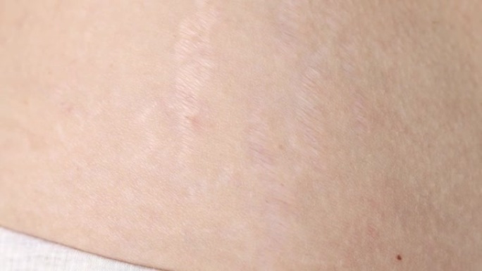人体有疤痕和妊娠纹特写。违反皮肤弹性。