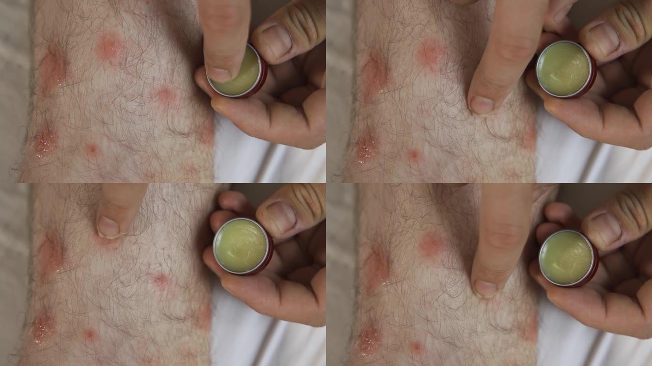 治疗性皮疹在腿上的应用软膏。用软膏治疗牛皮癣，美容和皮肤病学问题