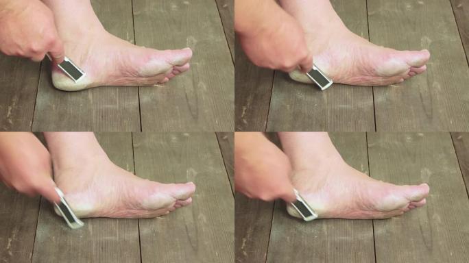 一只手用金属刮刀清理脚后跟的鸡眼。