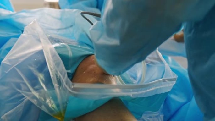 外科医生对膝盖骨进行内镜操作。医生在膝关节做关节镜手术，在手术室使用现代关节镜工具