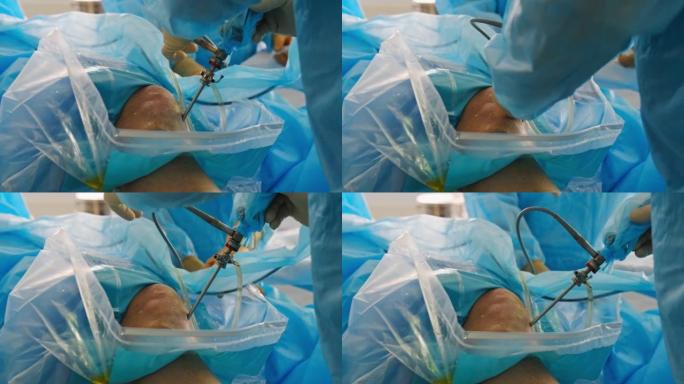外科医生对膝盖骨进行内镜操作。医生在膝关节做关节镜手术，在手术室使用现代关节镜工具