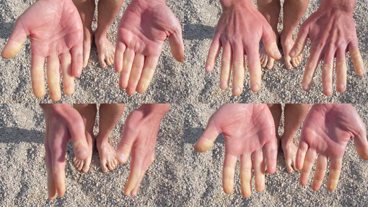 雷诺综合征患者在发作时的手。