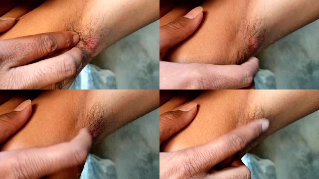 腋下痤疮库存视频录像的特写镜头