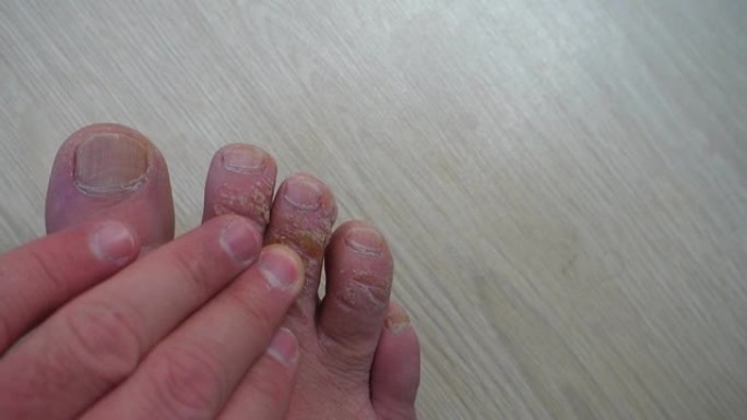 脚趾上有老茧的人抓伤他的手指，检查它们，老茧的手指，