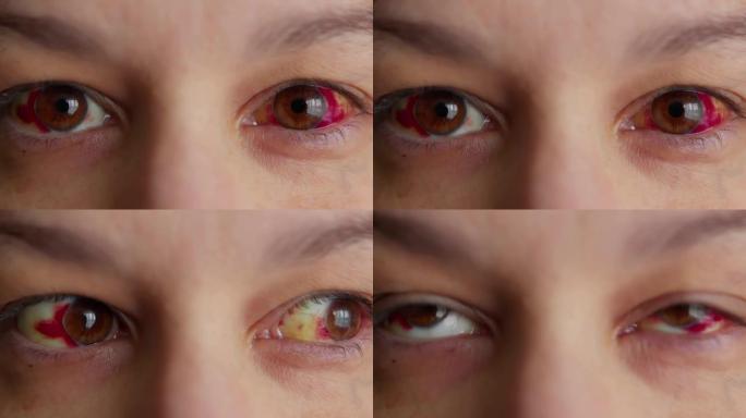 青光眼。女性红眼睛里满是血。毛细血管破裂，眼白发红，出血。艰难的分娩。过度劳累。压力。体力消耗乏力。