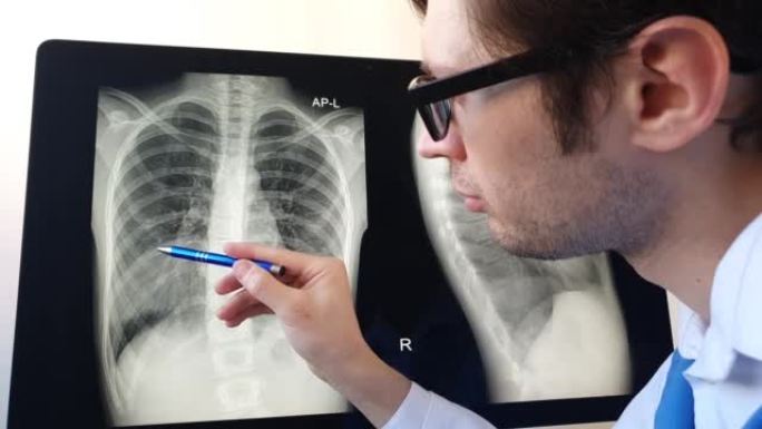 放射科医生分析右半胸肺肺炎的胸部x光。