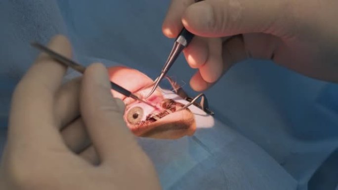 手术团队使用现代技术，现代诊所的最新设备进行斜视手术，外科医生缝制眼睛