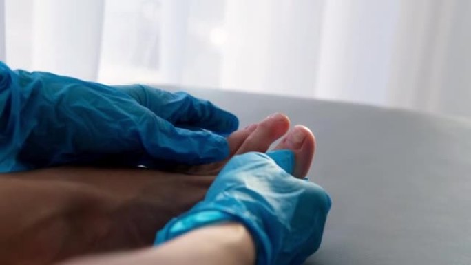 医生戴着手套检查指甲上有真菌的1英尺特写镜头。甲癣: 指甲从甲床上脱离。