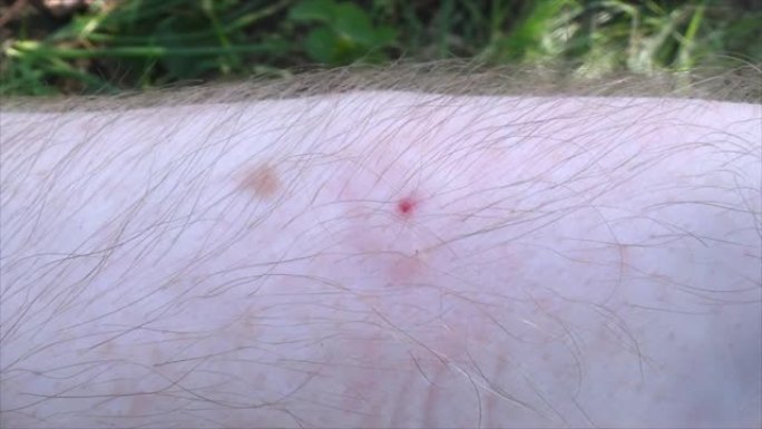 蜜蜂刺痛了养蜂人的手。特写-被咬引起的炎症部位。