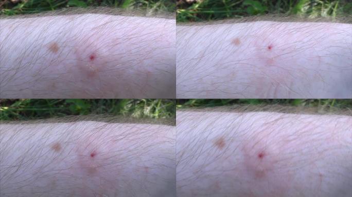 蜜蜂刺痛了养蜂人的手。特写-被咬引起的炎症部位。