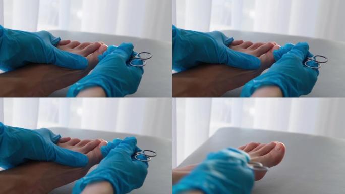 用指甲上的真菌1英尺的特写镜头由医生用剪刀清洁医生戴手套。甲癣: 指甲从甲床上脱离。