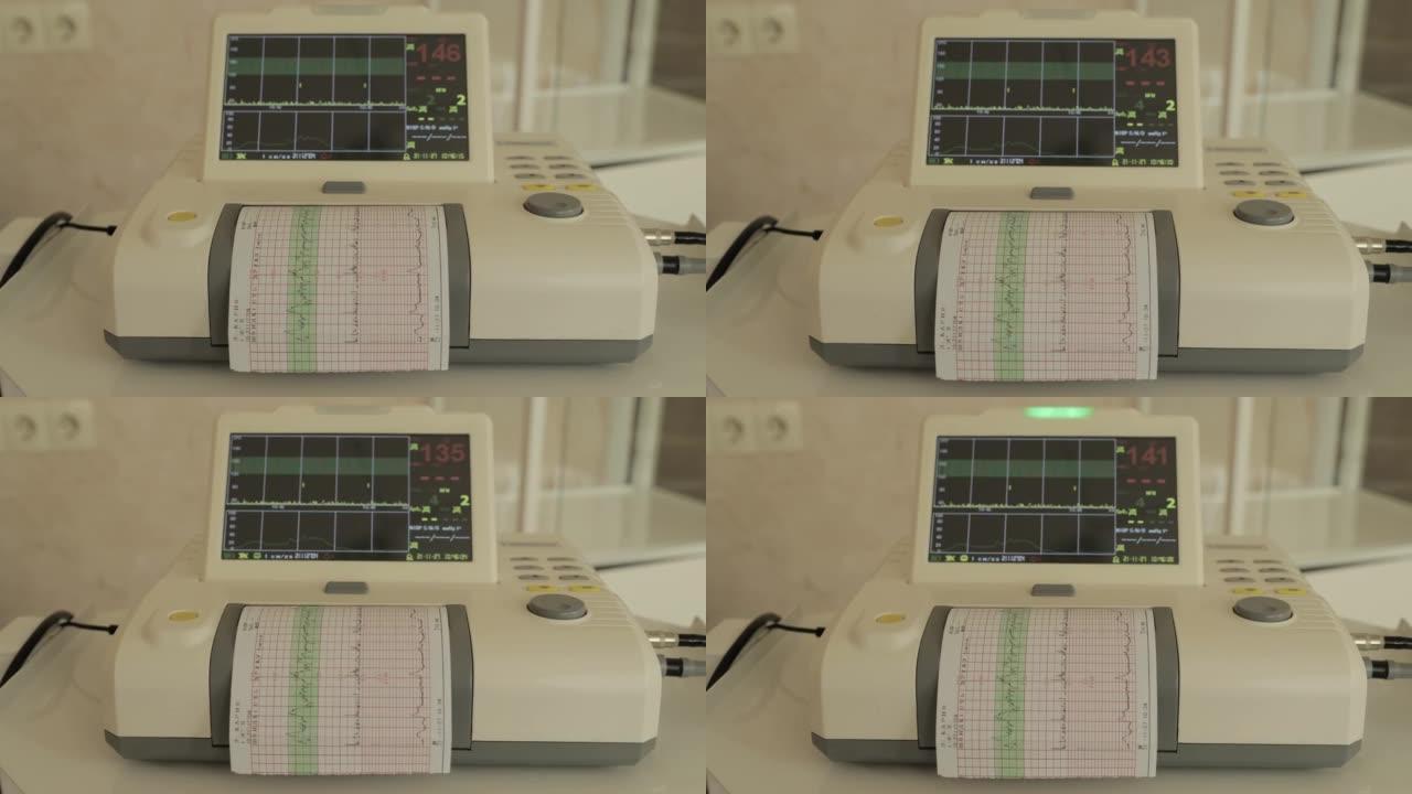 病人心跳的纸带心电图。