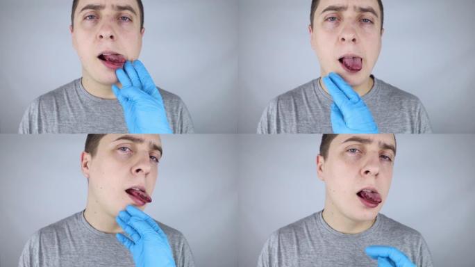 黑色舌头。一个人表现出舌头受伤，咬伤或烧伤的后果。零件损坏。内伤的治疗