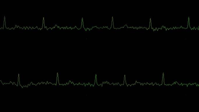 在个人使用(家庭使用)心电图上显示正常心律的心脏心电图