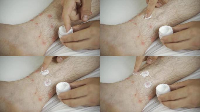 治疗性皮疹在腿上的应用软膏。用软膏治疗牛皮癣，美容和皮肤病学问题