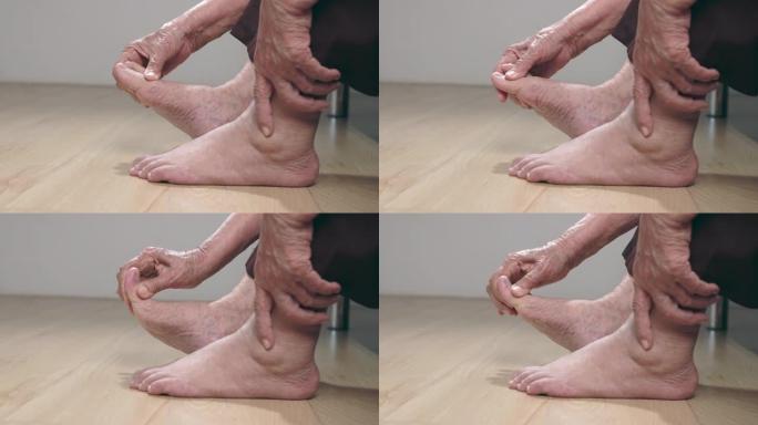 老年妇女按摩肿胀的脚。