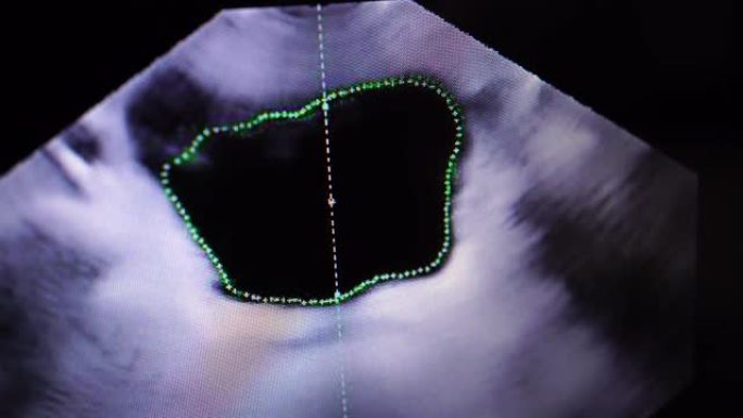 超声波屏幕监视器图像成像